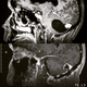 Illustration for article titled Not Dead Yet - Surviving a Brain Tumorem/em